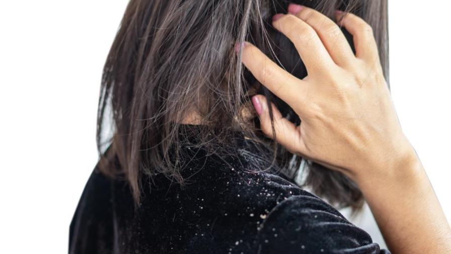 Prueba este remedio casero para eliminar la caspa de manera efectiva