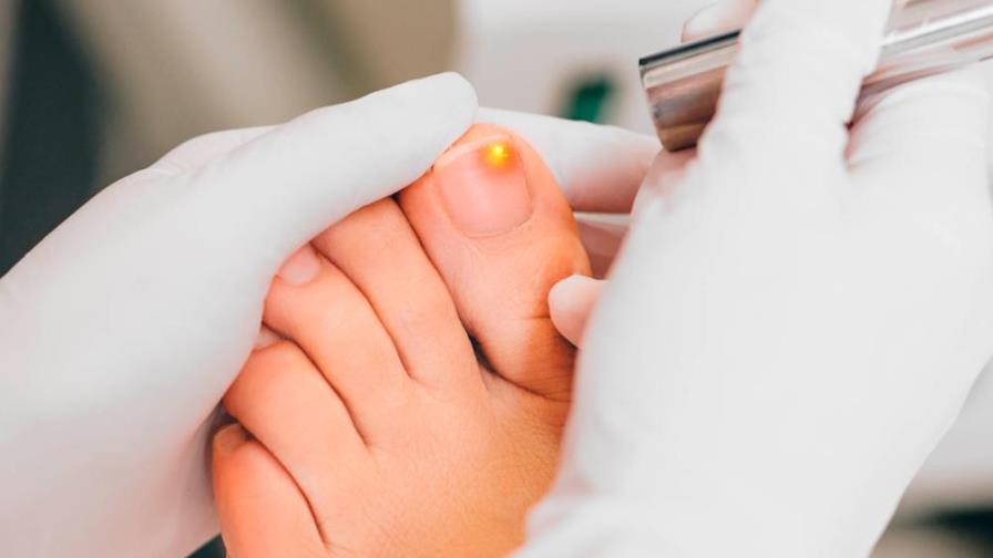Hongos en las uñas de los pies: ¿por qué aparecen y cómo curarlos?