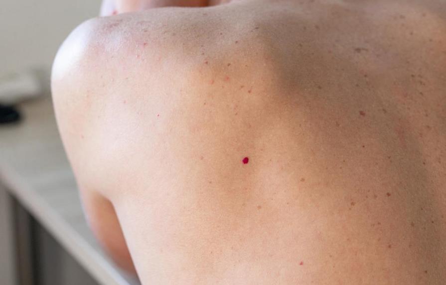 Por qué aparecen y qué son los puntos rojos en la piel