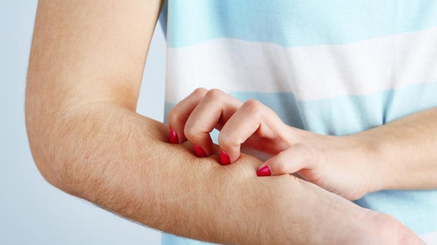 Así puedes bajar la inflamación de las picaduras de mosquito