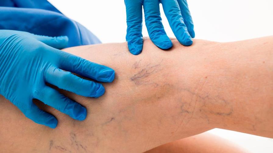 ¿Tienes várices? Evita estos hábitos