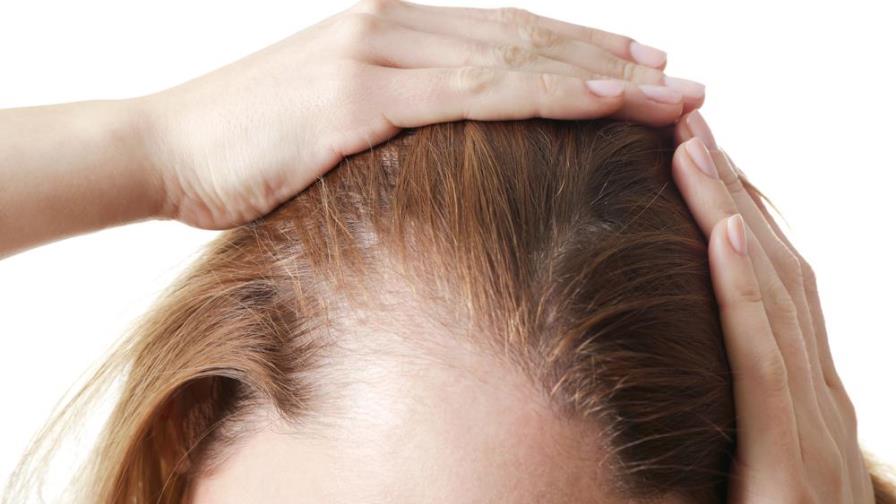 Motivos y detalles que delatan alopecia femenina