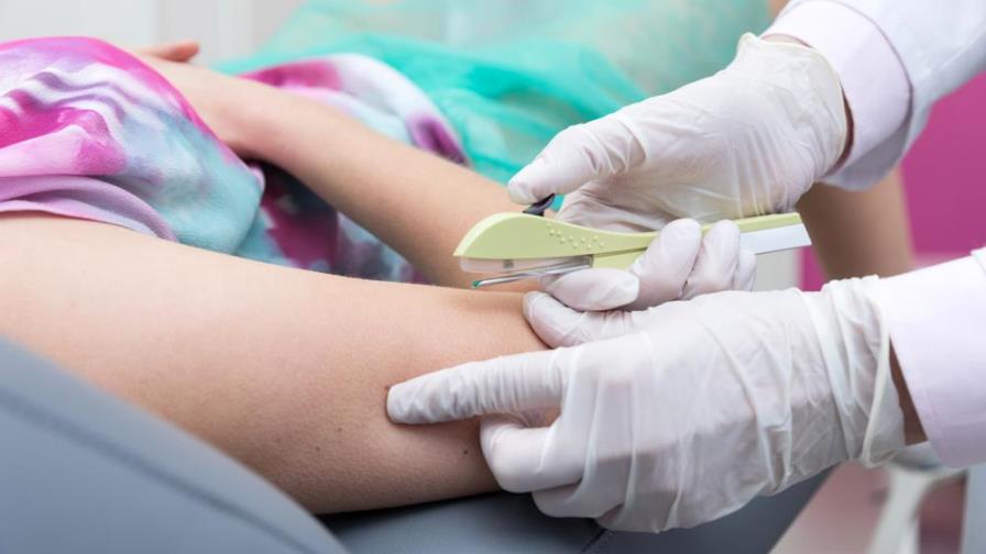 ¿Cómo funciona el implante anticonceptivo subdérmico? ¿Cómo funciona el implante anticonceptivo subdérmico?