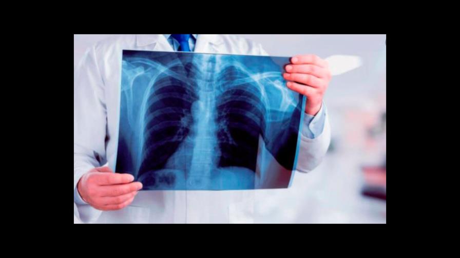 El 75% de los jóvenes positivos a tuberculosis en el hospital Santo Socorro fuma hookah El 75% de los jóvenes positivos a tuberculosis en el hospital Santo Socorro fuma hookah