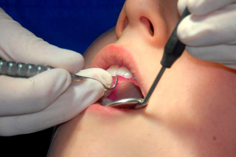 Acusan a un dentista de quemarle la boca a una niña de cinco años en EEUU