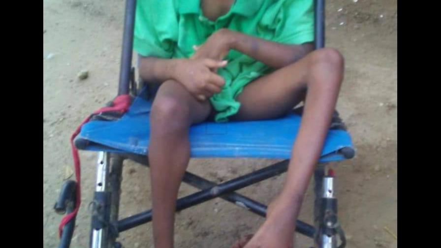 Madre pide ayuda para hijo que sufre parálisis cerebral y desnutrición crónica