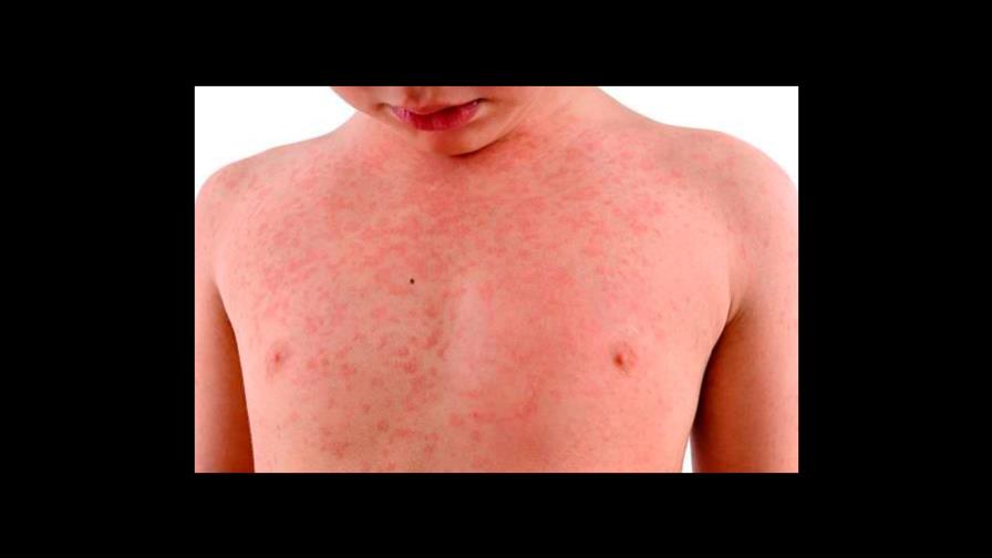 Doctora que identificó enfermedad de Kawasaki y explica cómo la diagnosticó Doctora que identificó enfermedad de Kawasaki y explica cómo la diagnosticó