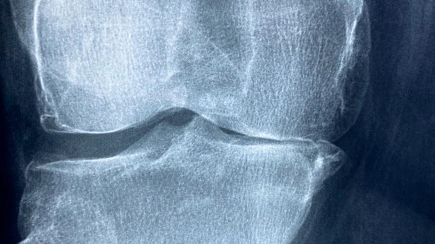 La artritis reumatoide es una enfermedad que “te enseña a vivir con el dolor”