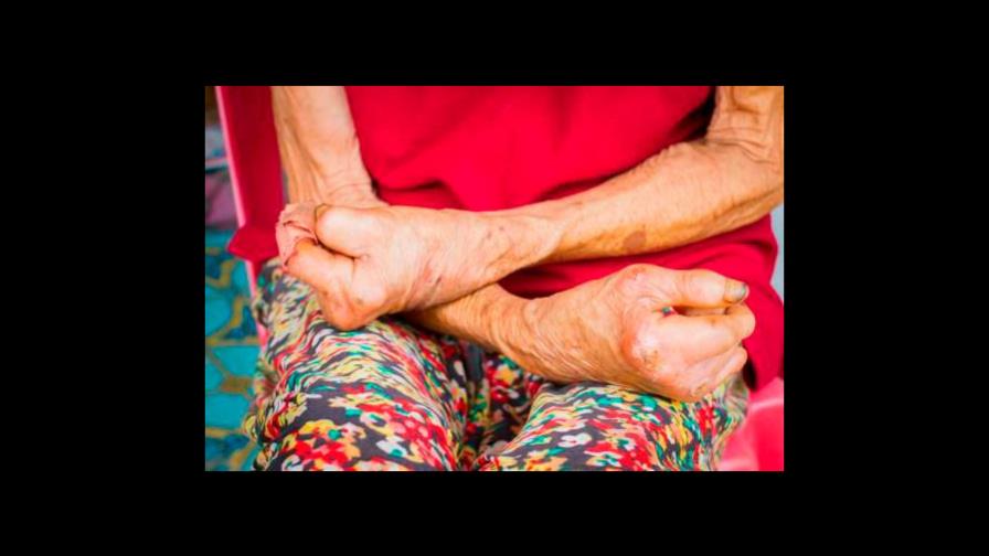 Instituto Dermatológico presenta la campaña “Tu piel, mi piel” por el mes de lucha contra la lepra