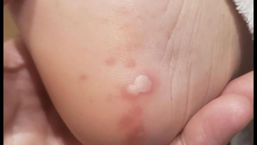 Estudio muestra las cinco manifestaciones del coronavirus en la piel 