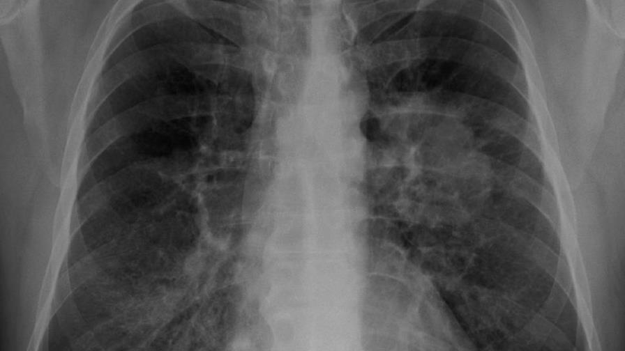 Cáncer de pulmón puede incrementar hasta 34 % riesgo de gravedad en covid-19