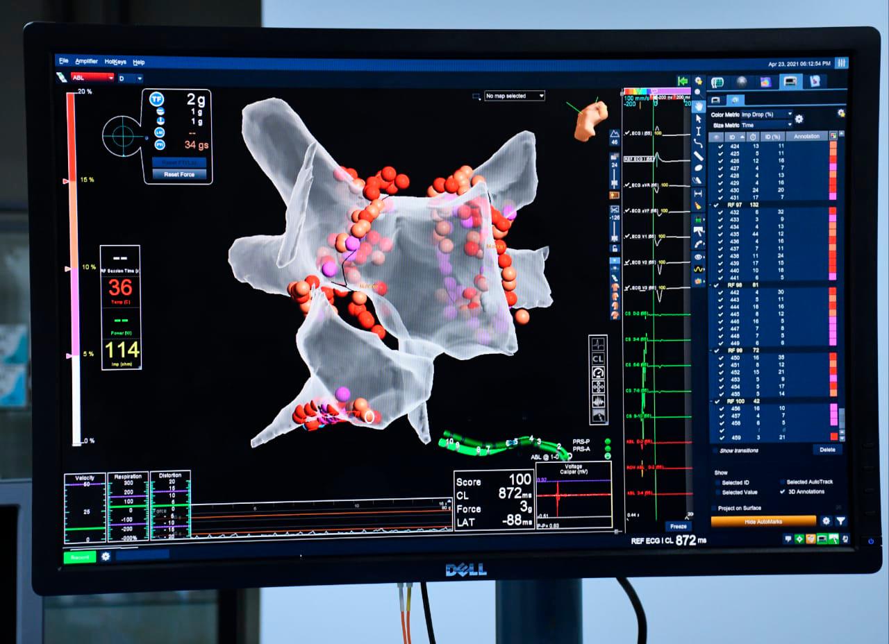 MAPA electroanatómico de la Auricular izquierda, utilizando el sistema Precisión - Abbott. Las lesiones (en rojo) creadas utilizando energía por radiofrecuencia, usando los catéteres de última generación Tacti cath. Catéteres con sensores de contacto y temperatura, los cuales permiten la creación de lesiones más duraderas seguras y definitivas. 