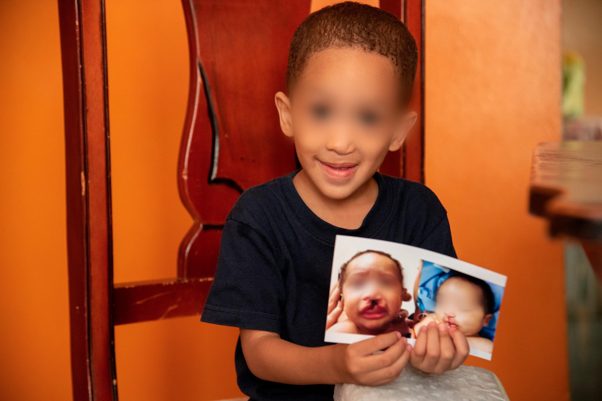 El hijo de Yenny sostiene una fotografía que muestra cómo lucía cuando nació con hendidura de labio y paladar. Tras tres cirugías y terapia, a sus 2 años de edad se ha recuperado.
