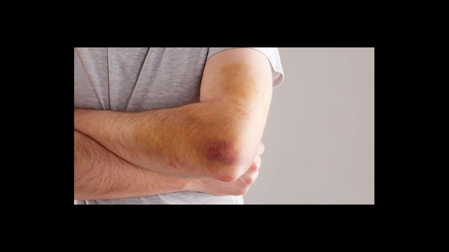 ¿Tienes moretones y hematomas, pero no te has golpeado? Estas podrían ser las causas
