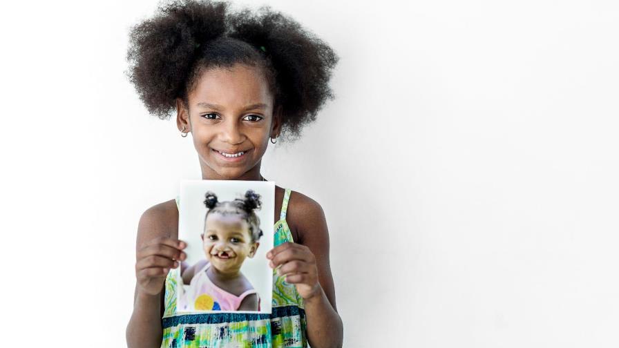 Realizarán cirugías gratuitas a niños con labio y paladar hendido 