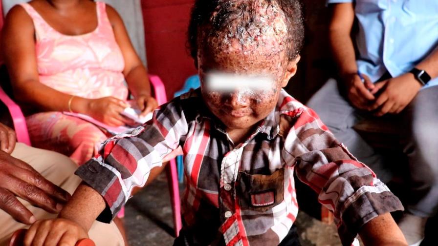 Ronny, el niño al que una enfermedad lo obliga a estar en la oscuridad 