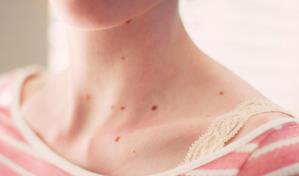 Controlar los lunares es fundamental: lo que debes saber