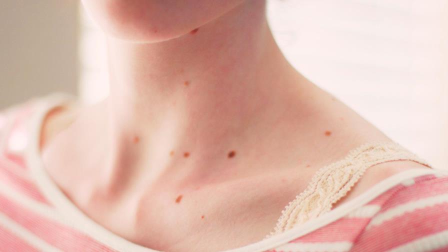 Controlar los lunares es fundamental: lo que debes saber
