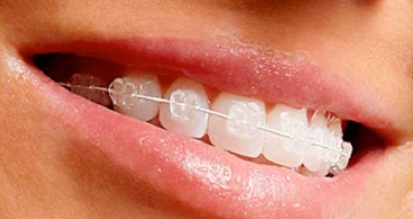 La ortodoncia no asegura la salud bucal a largo plazo, según estudio