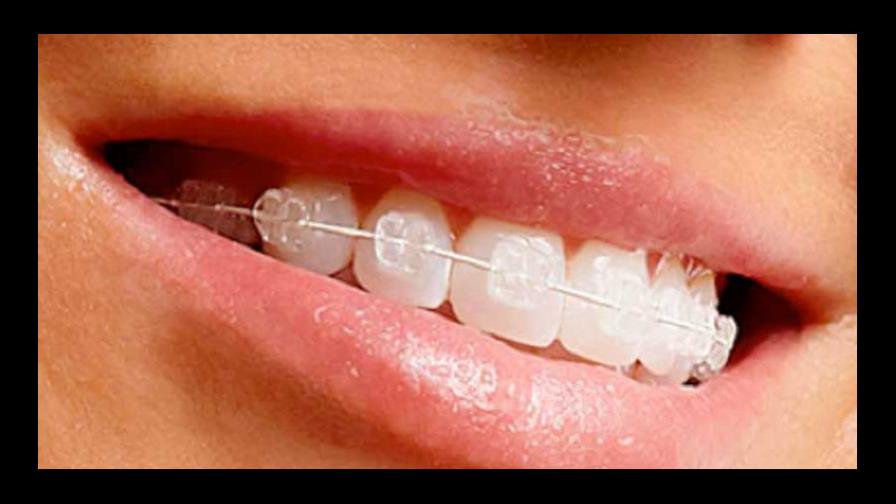 La ortodoncia no asegura la salud bucal a largo plazo, según estudio