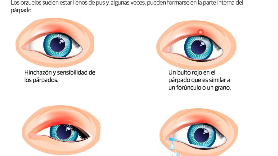 ¿Cómo prevenir su aparición?