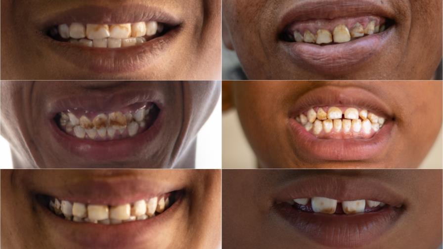 Dientes manchados: el problema que conecta a pueblos de Azua