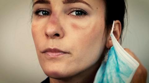 Uso de mascarilla provoca aumento en la dermatitis seborreica y en las lesiones de la piel