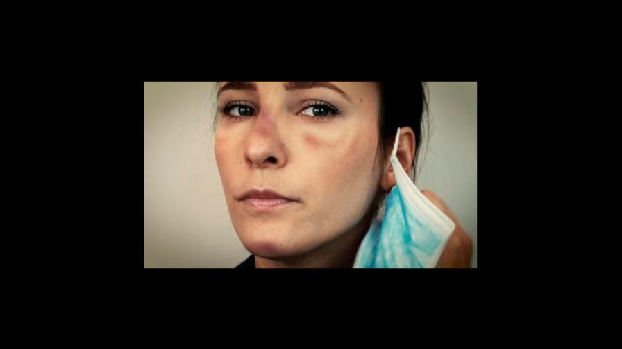 Uso de mascarilla provoca aumento en la dermatitis seborreica y en las lesiones de la piel