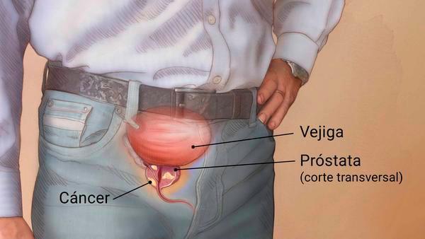 ?Cáncer de próstata, ¿algún alimento relacionado?