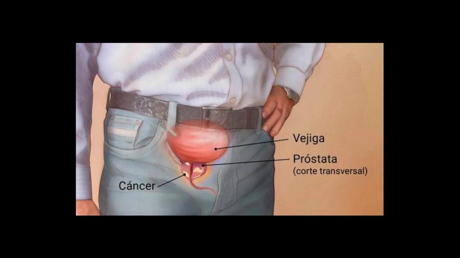 ?Cáncer de próstata, ¿algún alimento relacionado?