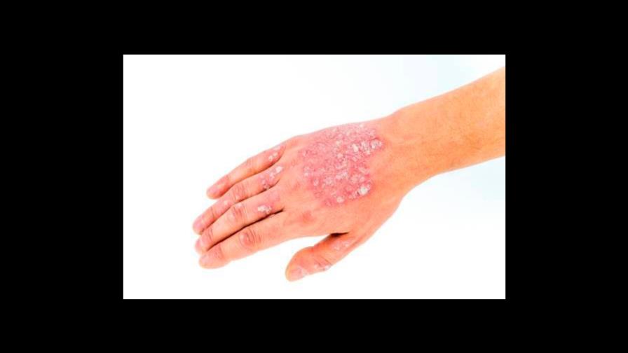 Las recomendaciones de una dermatóloga a los pacientes con psoriasis