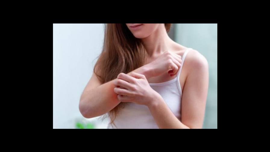 ¿A qué se debe la psoriasis y cómo tratarla?