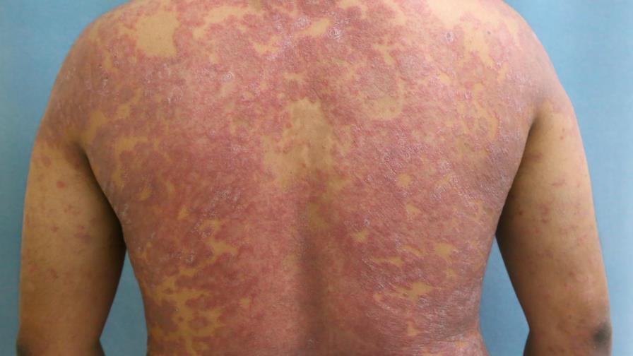 Más de 500 pacientes con psoriasis reciben tratamiento en el Instituto Dermatológico Más de 500 pacientes con psoriasis reciben tratamiento en el Instituto Dermatológico
