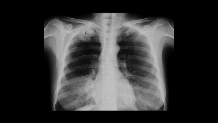 La tuberculosis puede curarse con tratamientos más cortos, según estudio