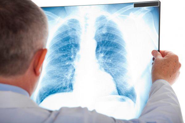 Recomendaciones para pacientes con hipertensión pulmonar en época de COVID-19 