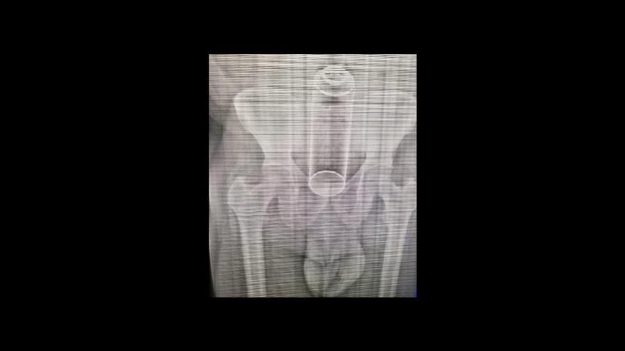 Hombre que tenía objeto en el recto se encuentra estable 