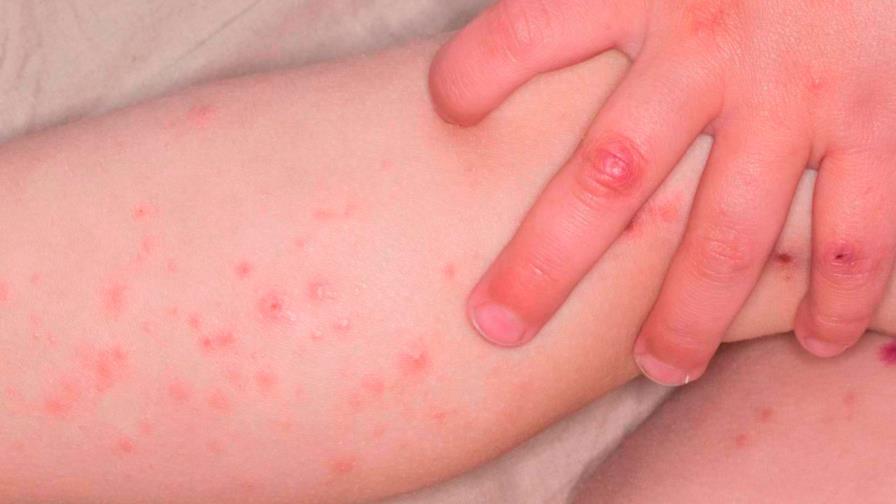 ONU registra numerosos brotes de sarampión en el mundo