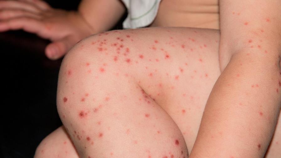 El sarampión alcanza un récord en EE.UU. desde que se erradicó la enfermedad