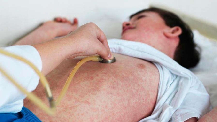 OPS alerta sobre peligro del sarampión en era de coronavirus OPS alerta sobre peligro del sarampión en era de coronavirus