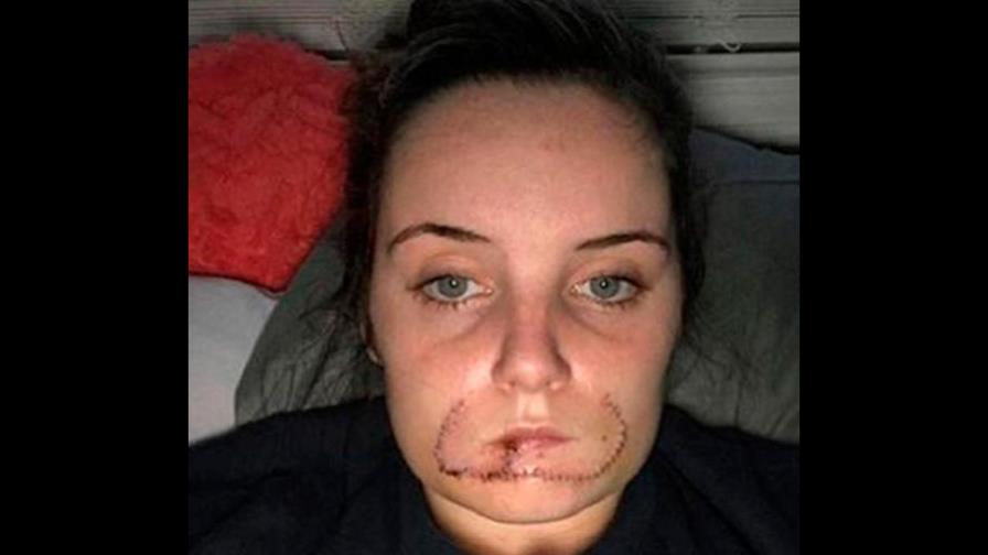 Hombre arrancó el labio de su exnovia de una mordida Hombre arrancó el labio de su exnovia de una mordida