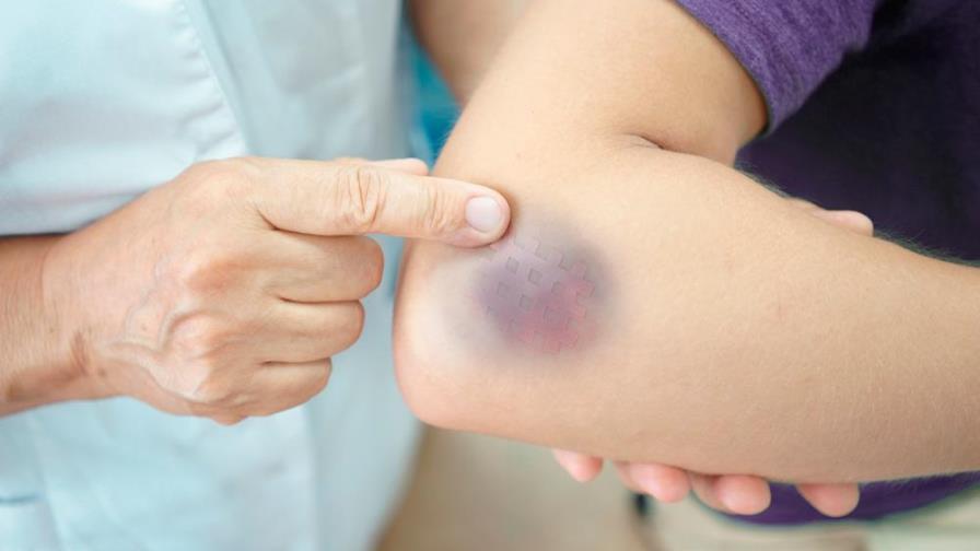 ¿Por qué se producen los hematomas?