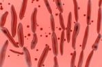 Síntomas de botulismo, una de las toxinas más mortales que existen Síntomas de botulismo, una de las toxinas más mortales que existen