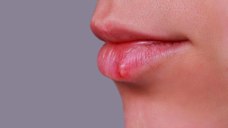 Herpes labial: estas son las 3 causas principales