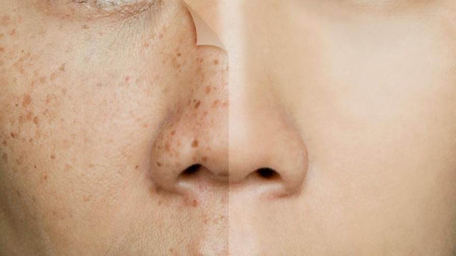 Cómo prevenir las manchas faciales