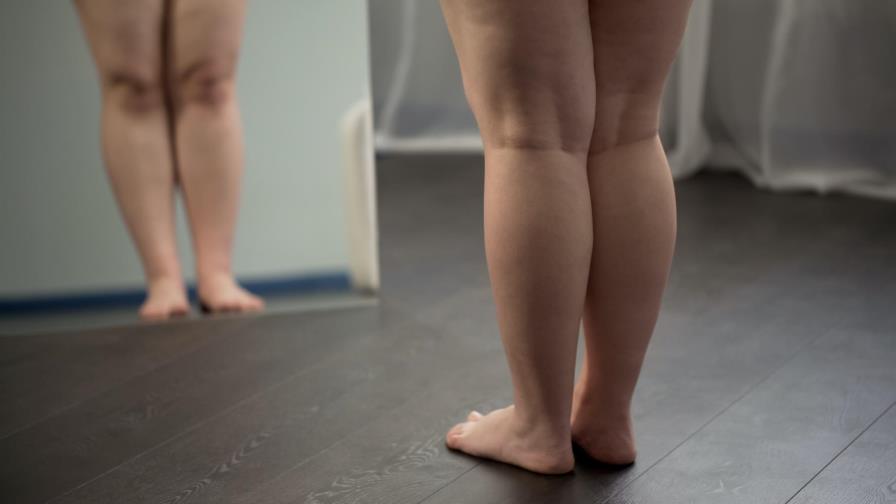 Lipedema, la rara enfermedad que suele confundirse con obesidad y celulitis