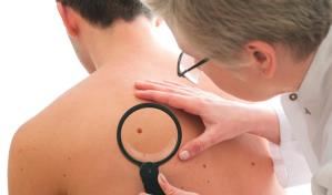 Estas son las principales diferencias entre los lunares y los melanomas