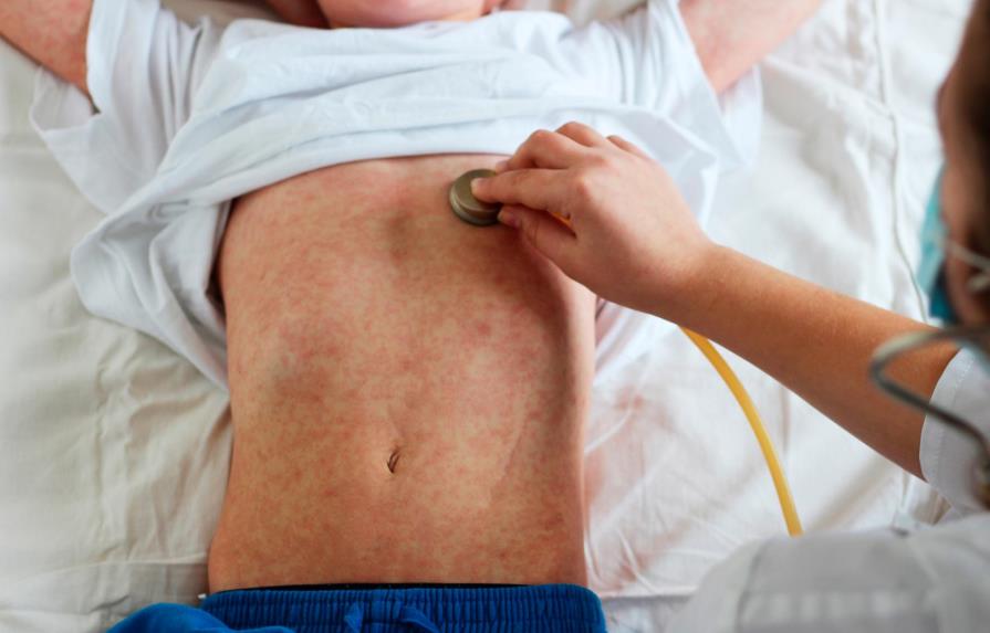 OMS alerta sobre alarmante aumento del sarampión y problemas en vacunación
