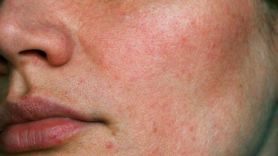 Consejos básicos para eliminar el exceso de grasa y el brillo de la cara Consejos básicos para eliminar el exceso de grasa y el brillo de la cara