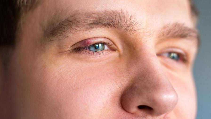 Por estas razones salen los orzuelos