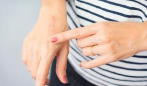 Cómo mejorar la apariencia de las cicatrices